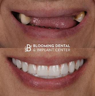 Complete implant dentistry before and after