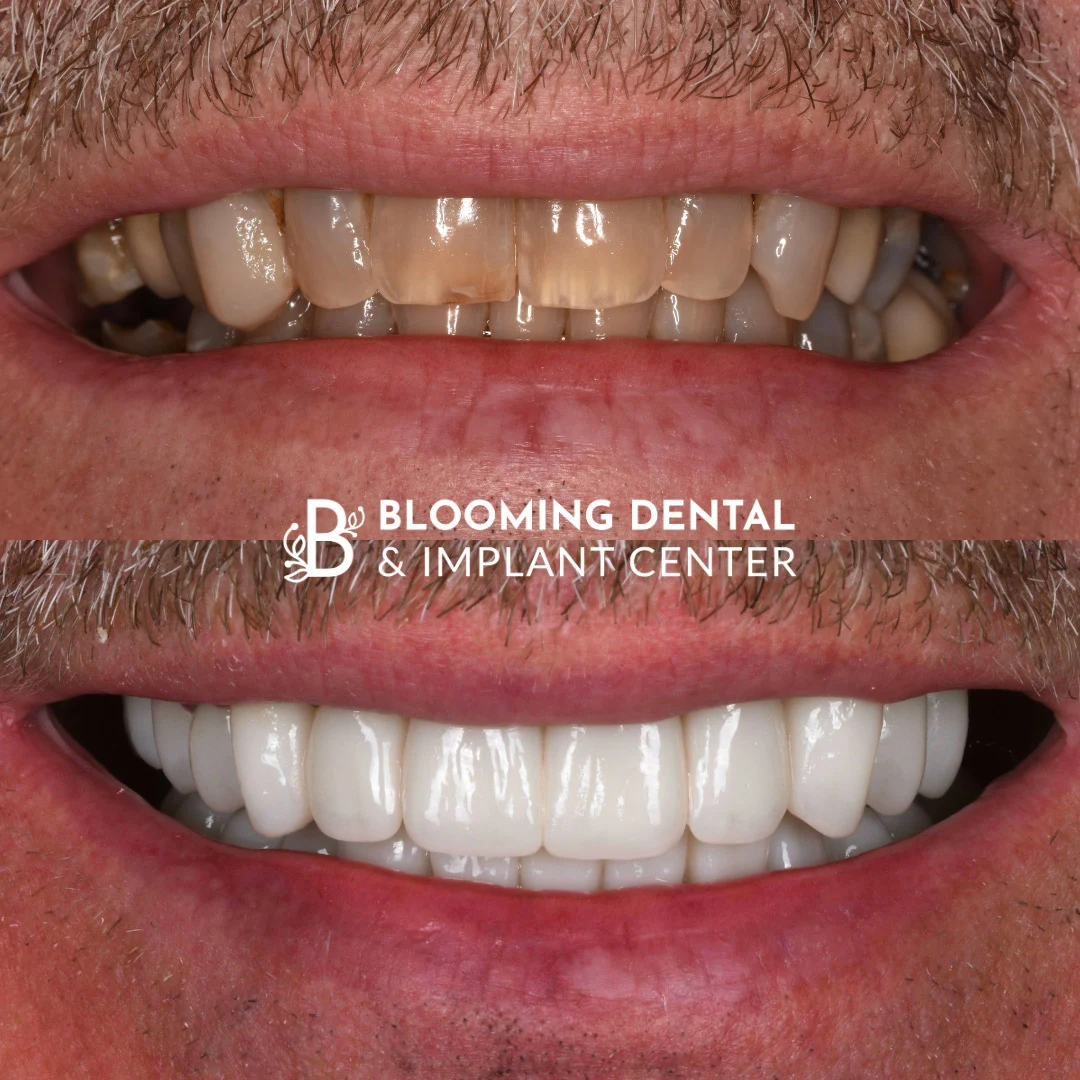 Full mouth reconstruction before and after